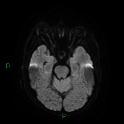 File:Cerebral amyloid angiopathy (Radiopaedia 77506-89664 Axial DWI 11).jpg