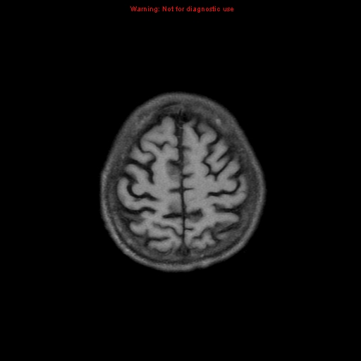 File:Cerebral and orbital tuberculomas (Radiopaedia 13308-13311 Axial T1 18).jpg