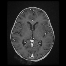 Cerebral and spinal tuberculosis (Radiopaedia 90489-107837 Axial T1 C+ 106).jpg