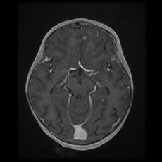 Cerebral and spinal tuberculosis (Radiopaedia 90489-107837 Axial T1 C+ 88).jpg