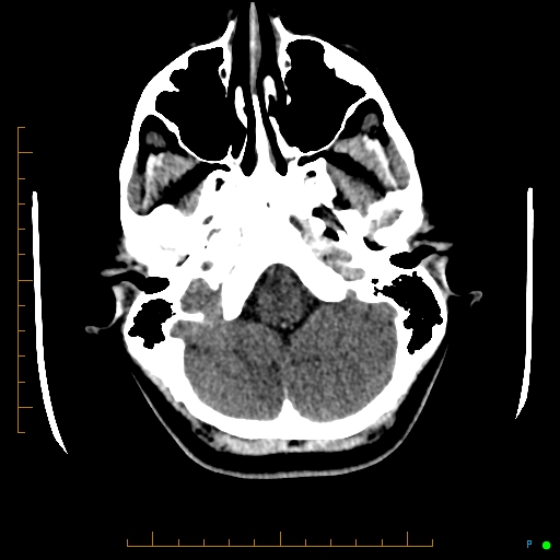 Cerebral arteriovenous malformation (AVM) (Radiopaedia 78162-90706 Axial non-contrast 13).jpg