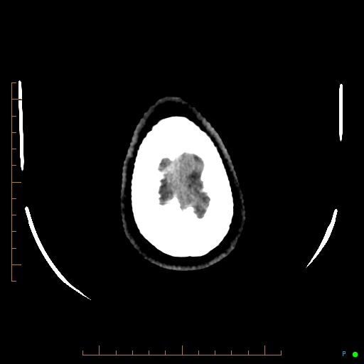 Cerebral arteriovenous malformation (AVM) (Radiopaedia 78162-90706 Axial non-contrast 62).jpg