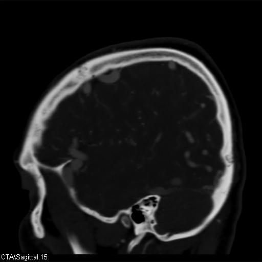 Cerebral arteriovenous malformation (Radiopaedia 28518-28759 D 12).jpg