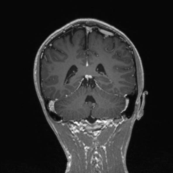Cerebral arteriovenous malformation (Radiopaedia 30198-30813 F 40).jpg