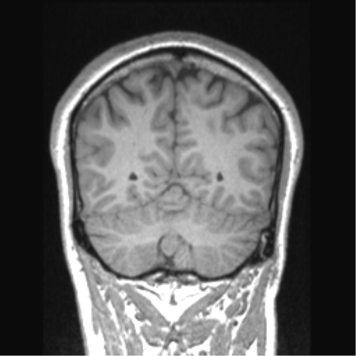 Cerebral arteriovenous malformation (Radiopaedia 39259-41506 Coronal T1 26).png
