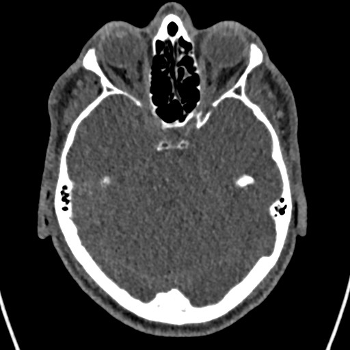 File:Cerebral arteriovenous malformation (Radiopaedia 78188-90746 Axial non-contrast 57).jpg