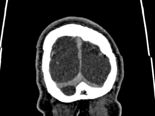 Cerebral arteriovenous malformation (Radiopaedia 78188-90746 Coronal C+ delayed 121).jpg