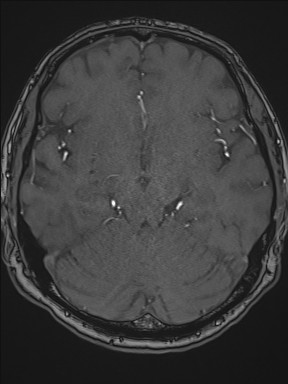 Cerebral arteriovenous malformation (Radiopaedia 84015-99245 Axial TOF 108).jpg