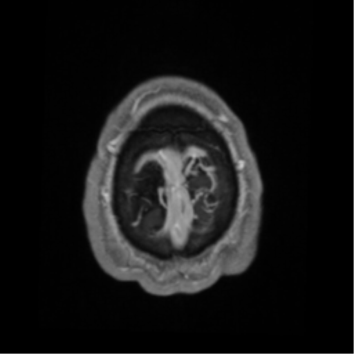 Cerebral arteriovenous malformation - huge (Radiopaedia 35734-37272 Axial T1 C+ 71).png