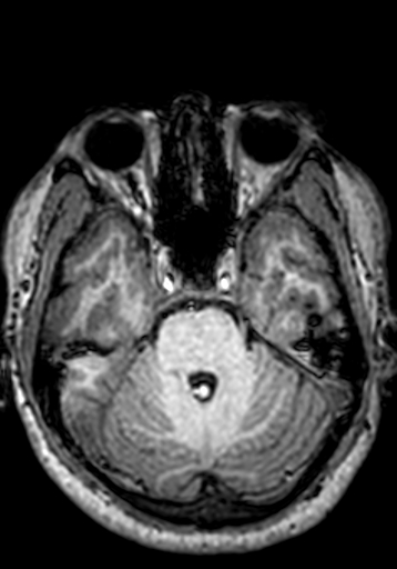 Cerebral arteriovenous malformation at posterior body of corpus callosum (Radiopaedia 74111-84925 Axial T1 221).jpg