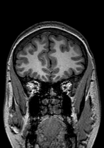 Cerebral arteriovenous malformation at posterior body of corpus callosum (Radiopaedia 74111-84925 Coronal T1 56).jpg