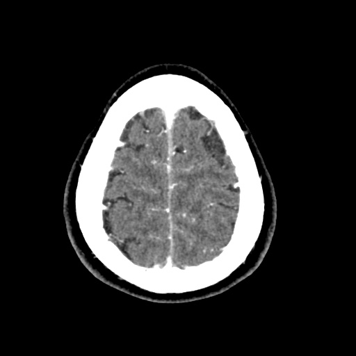 Cerebral arteriovenous malformation with lobar hemorrhage (Radiopaedia 35598-57216 A 54).jpg