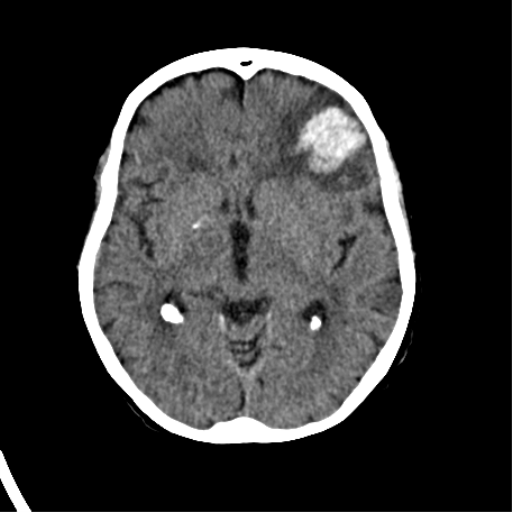 File:Cerebral arteriovenous malformation with lobar hemorrhage (Radiopaedia 44725-48510 Axial non-contrast 21).png