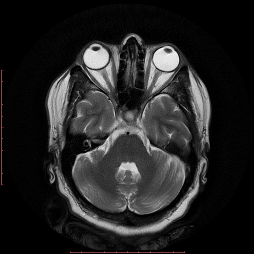 File:Cerebral cavernous malformation (Radiopaedia 26177-26306 Axial T2 7).jpg