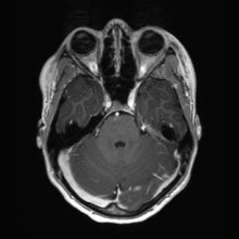 Cerebral cavernous venous malformation (Radiopaedia 70008-80021 Axial T1 C+ 20).jpg