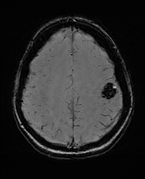 Cerebral cavernous venous malformation (Radiopaedia 70008-80021 I 56).jpg