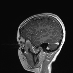 Cerebral cavernous venous malformation (Radiopaedia 70008-80021 Sagittal T1 C+ 58).jpg