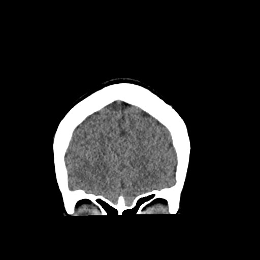Cerebral cavernous venous malformation (Radiopaedia 70008-80022 non-contrast 12).jpg