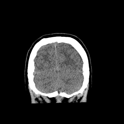 Cerebral cavernous venous malformation (Radiopaedia 70008-80022 non-contrast 61).jpg