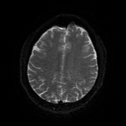 Cerebral cavernous venous malformation (Zabramski type II) (Radiopaedia 85511-101198 Axial DWI 88).jpg