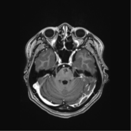 File:Cerebral cavernous venous malformations (Radiopaedia 48117-52946 Axial T1 C+ 14).png