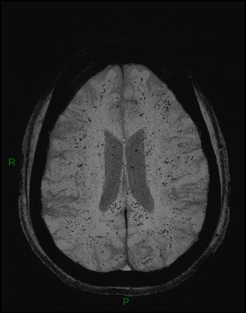 Cerebral fat embolism (Radiopaedia 35022-36525 Axial SWI 32).jpg