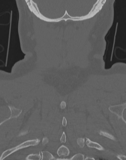 Cerebral hemorrhagic contusions and cervical spine fractures (Radiopaedia 32865-33841 Coronal bone window 70).jpg
