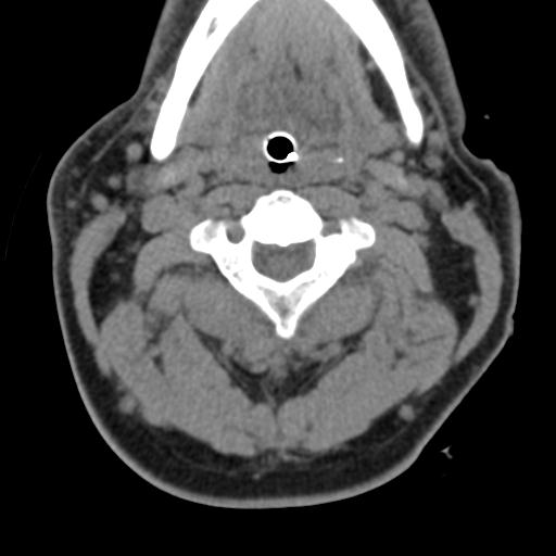 Cerebral hemorrhagic contusions and cervical spine fractures (Radiopaedia 32865-33841 F 20).jpg