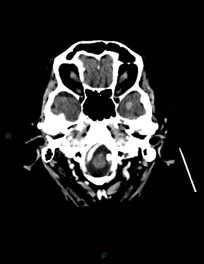 Cerebral metastases - ependymal and parenchymal (Radiopaedia 79877-93131 Axial C+ delayed 9).jpg