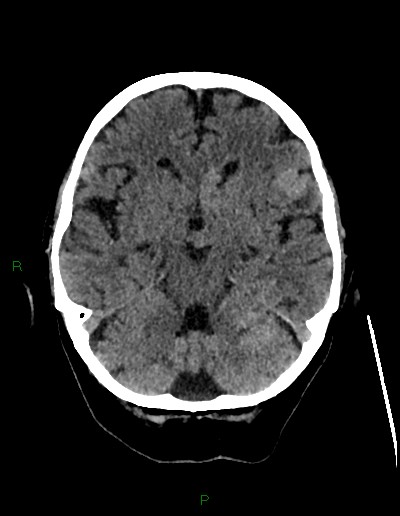 Cerebral metastases - ependymal and parenchymal (Radiopaedia 79877-93131 Axial non-contrast 25).jpg