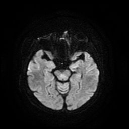 File:Cerebral metastases - melanoma (Radiopaedia 80972-94522 Axial DWI 45).jpg