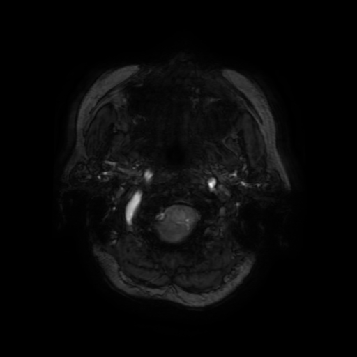 Cerebral metastases - melanoma (Radiopaedia 80972-94522 Axial SWI 5).jpg