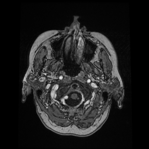 File:Cerebral metastases - melanoma (Radiopaedia 80972-94522 Axial T1 C+ 22).jpg