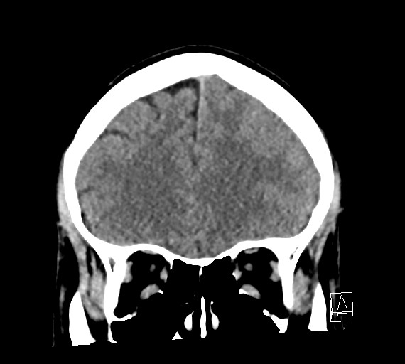Cerebral metastases - testicular choriocarcinoma (Radiopaedia 84486-99855 Coronal C+ delayed 18).jpg