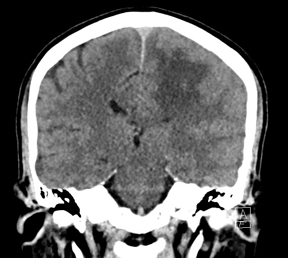 Cerebral metastases - testicular choriocarcinoma (Radiopaedia 84486-99855 Coronal C+ delayed 36).jpg