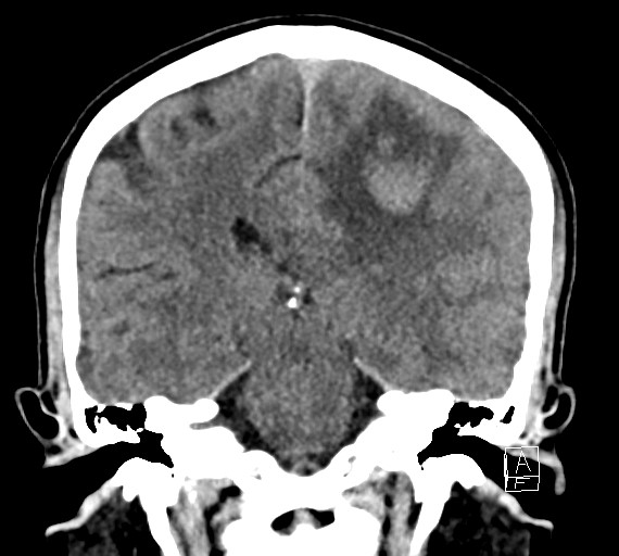 Cerebral metastases - testicular choriocarcinoma (Radiopaedia 84486-99855 Coronal C+ delayed 37).jpg
