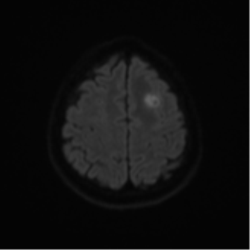 File:Cerebral metastases mimicking abscesses (Radiopaedia 45841-50131 Axial DWI 51).png