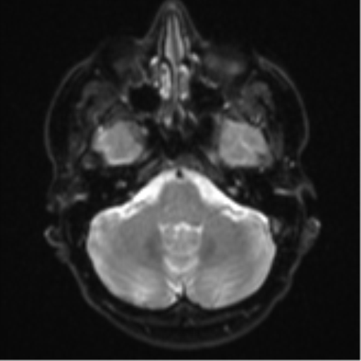 Cerebral metastasis - colorectal adenocarcinoma (Radiopaedia 50394-55765 Axial DWI 5).png