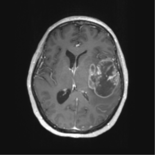 Cerebral metastasis mimicking glioblastoma (Radiopaedia 69155-78937 Axial T1 C+ 36).png