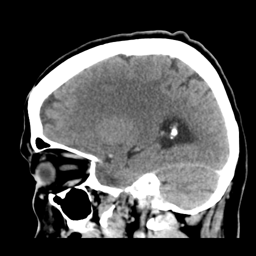 File:Cerebral metastasis to basal ganglia (Radiopaedia 81568-95412 Sagittal C+ delayed 39).png
