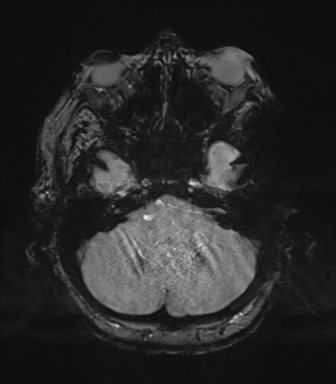 Cerebral metastasis to basal ganglia (Radiopaedia 81568-95413 Axial SWI magnitude 16).png