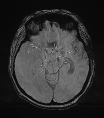 Cerebral metastasis to basal ganglia (Radiopaedia 81568-95413 Axial SWI magnitude 34).png