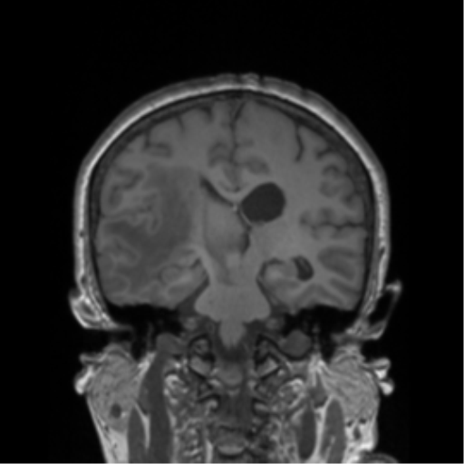 Cerebral metastasis to basal ganglia (Radiopaedia 81568-95413 Coronal T1 20).png