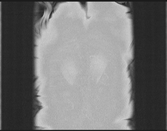 Cerebral metastasis to basal ganglia (Radiopaedia 81568-95414 Coronal lung window 83).png