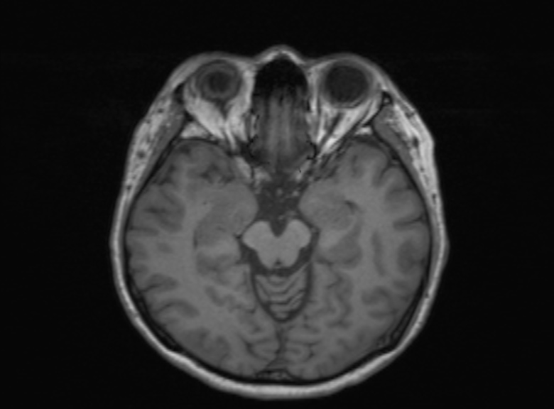 Cerebral ring enhancing lesions - cerebral metastases (Radiopaedia 44922-48817 Axial T1 261).jpg