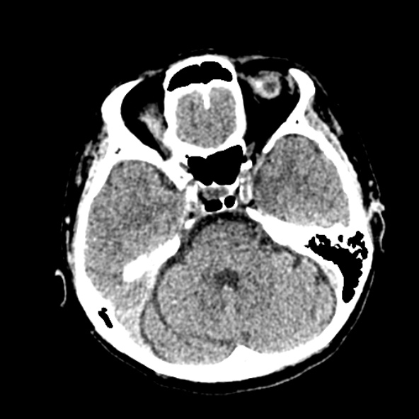 Cerebral ring enhancing lesions - cerebral metastases (Radiopaedia 44922-48818 Axial non-contrast 36).jpg