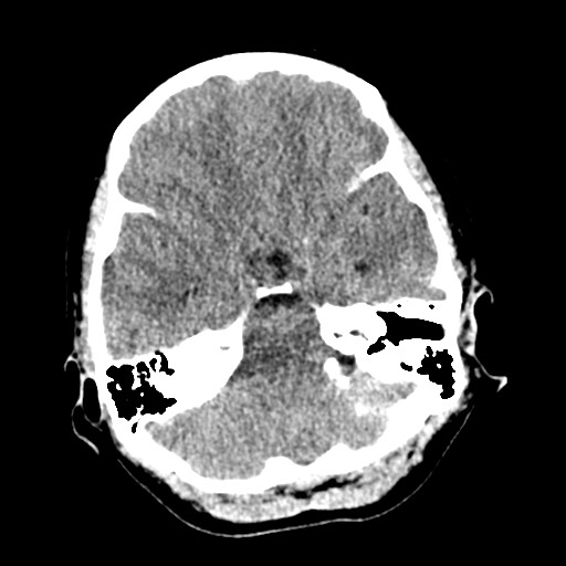 File:Cerebral tuberculosis with dural sinus invasion (Radiopaedia 60353-68018 Axial non-contrast 13).jpg