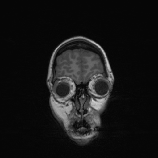 Cerebral tuberculosis with dural sinus invasion (Radiopaedia 60353-68090 Coronal T1 30).jpg