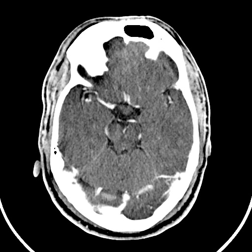 File:Cerebral venous angioma (Radiopaedia 69959-79977 B 27).jpg
