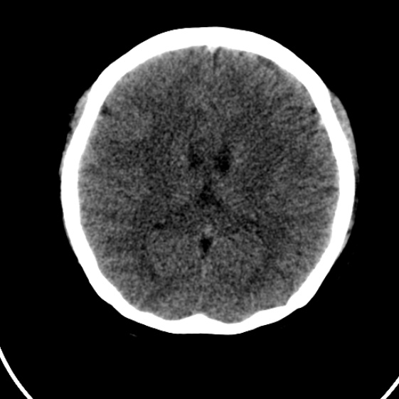 File:Cerebral venous hemorrhagic infarct from venous sinus thrombosis (Radiopaedia 55433-61879 Axial non-contrast 14).jpg
